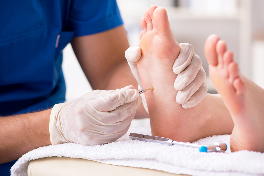 Wart Removal Melbourne